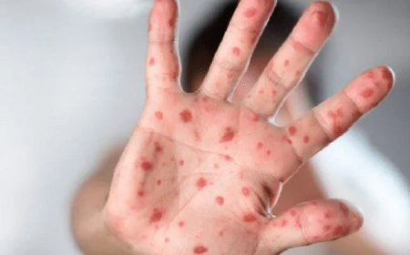 وزارة الصحة..تسجيل أول حالة إصابة بجدري القردة