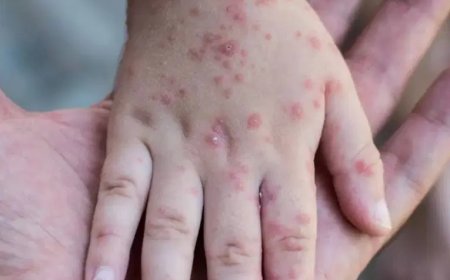 هذه هي الخطة التي ستعتمدها الحكومة للحد من انتشار داء الحصبة
