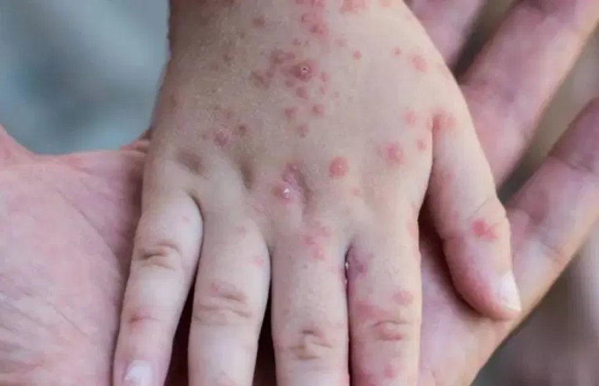 هذه هي الخطة التي ستعتمدها الحكومة للحد من انتشار داء الحصبة